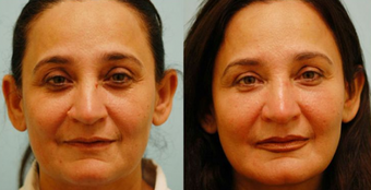 Fat Transfer/Fat Grafting/Facial Rejuvenation
