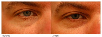 Mole Removal