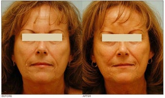 Mole Removal