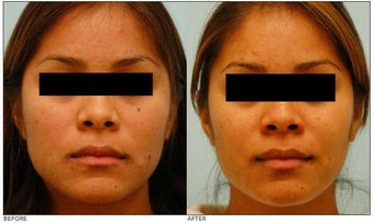 Mole Removal