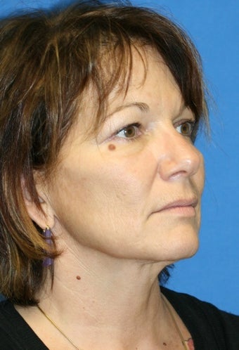 mole removal