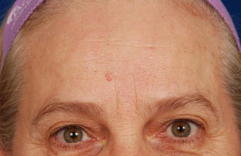 Mole Removal
