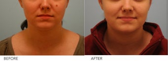 Mole Removal