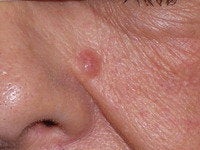 Basal Cell Carcinomas Excisions