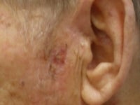 Basal Cell Carcinomas Excisions
