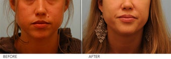 Mole Removal 