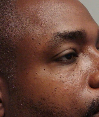 removal of dermatosis papulos nigra