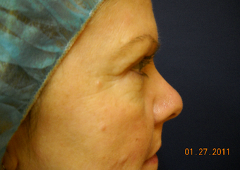 Mole Removal