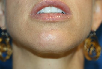 Mole Removal
