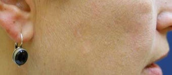 Mole Removal