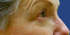 Mole Removal