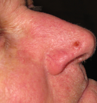 Skin cancer excision with skin graft repair