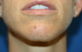 Mole Removal