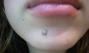 Mole Removal