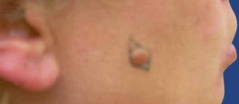 Mole Removal