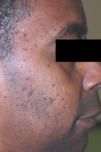 Los Angeles Mole Removal - Dermatosis Papulosa Nigra