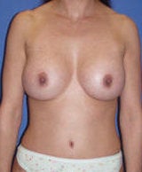 Abdominoplasty and Breast Augmentation Surgery