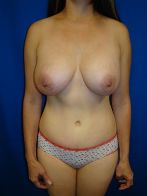 Tummy Tuck Surgery and Breast Augmentation