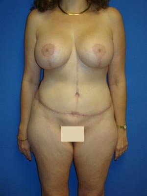 Tummy Tuck, Breast Lift with Implants