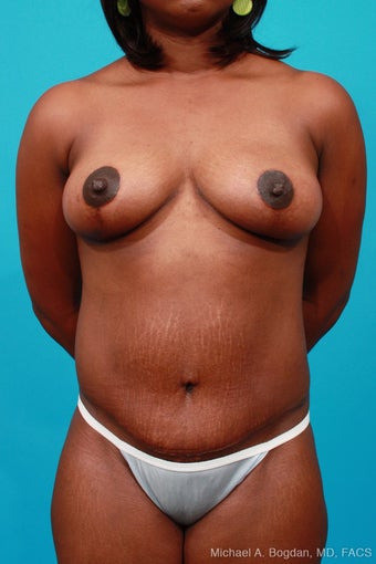 Mommy Makeover: Breast Lift & Extended Abdominoplasty