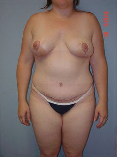 Mommy Makeover