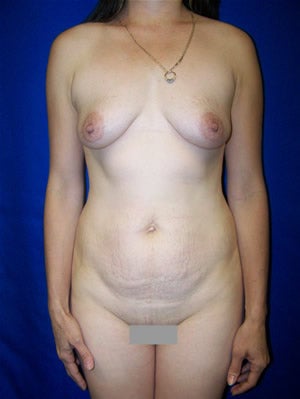 Tummy Tuck Surgery and Breast Augmentation