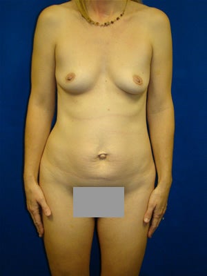 Tummy Tuck with Breast Augmentation Surgery