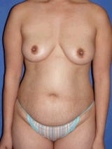 Tummy Tuck Surgery (abdominoplasty) and Breast Implants
