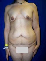 Extended Tummy Tuck Surgery. Breast Lift with Implants