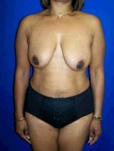 Extended Tummy Tuck with Breast Lift and Implants