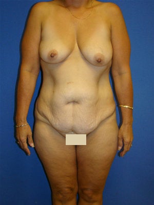 Extended Tummy Tuck, Breast Lift with Implants