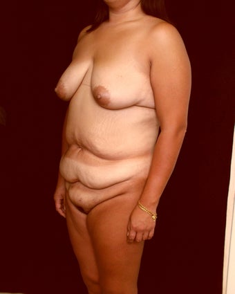 Mommy Makeover