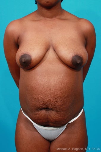 Mommy Makeover: Breast Lift & Extended Abdominoplasty