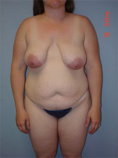 Mommy Makeover