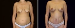 29 year old female, Mommy Makeover