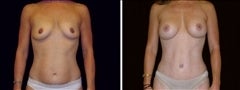 38 year old female, Mommy Makeover