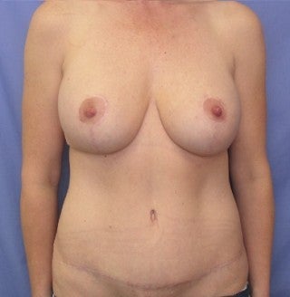 breast augmentation/ mastopexy with abdominoplasty