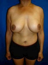 Breast Enhancement, ExtendedTummy Tuck (Abdominoplasty), Mommy Makeover