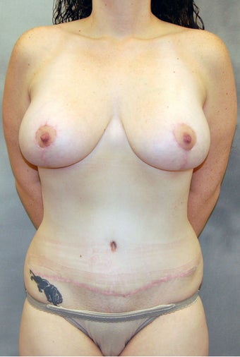 Abdominoplasty and Mastopexy with Implants