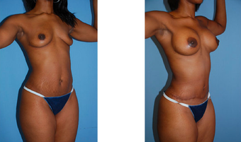 Tummy tuck, breast lift, breast implants, liposuction