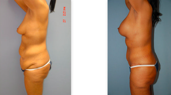 Tummy tuck, breast lift and implants, liposuction