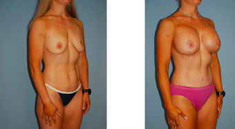 Tummy tuck, breast lift with implants, liposuction