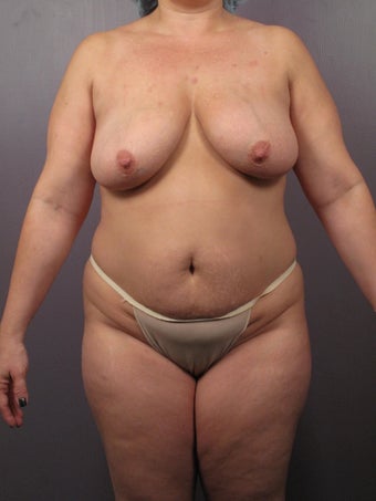 Mommy Makeover 