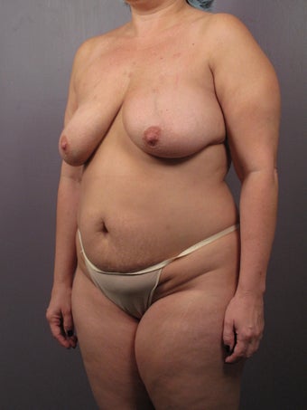 Mommy Makeover 