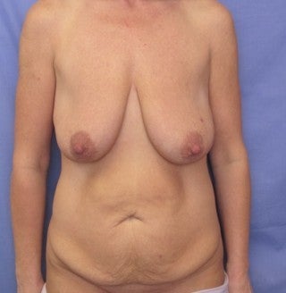 breast augmentation/ mastopexy with abdominoplasty