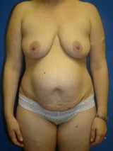 Breast Augmentation Mastopexy and Abdominoplasty