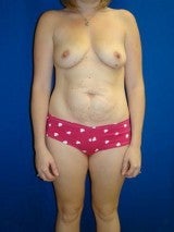 Breast Augmentation Mastopexy and Abdominoplasty