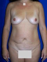 Breast Augmentation and Abdominoplasty