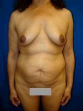 Breast Enhancement, ExtendedTummy Tuck (Abdominoplasty), Mommy Makeover