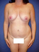 Tummy Tuck (Abdominoplasty), Breast Augmentation, Mommy Makeover